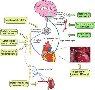 Autonomic Neuromodulation for Preventing and Treating Ventricular Arrhythmias